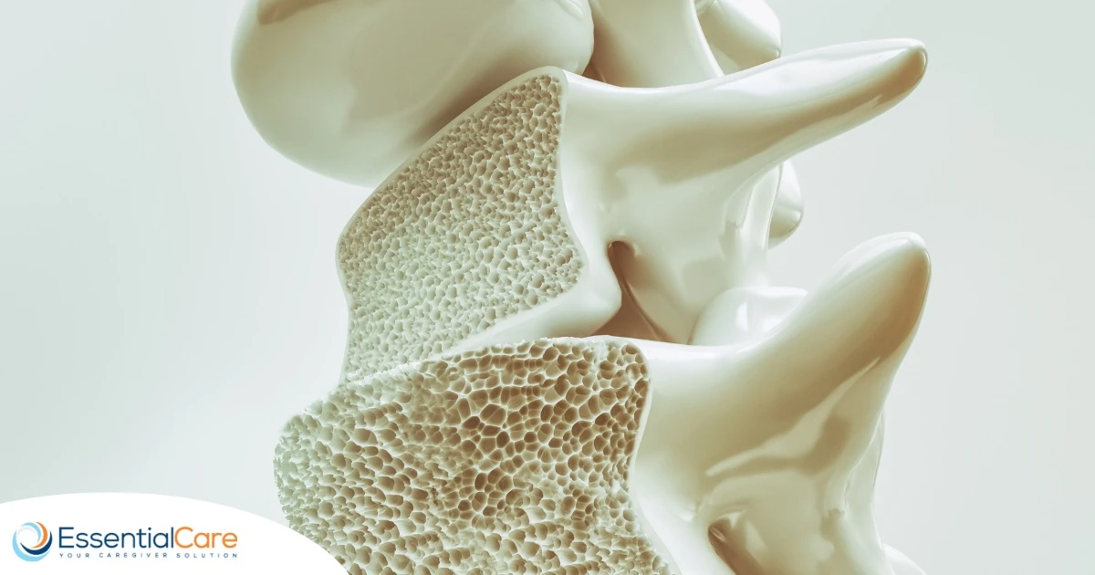 What Is Osteoporosis? Causes, Symptoms, and Treatments